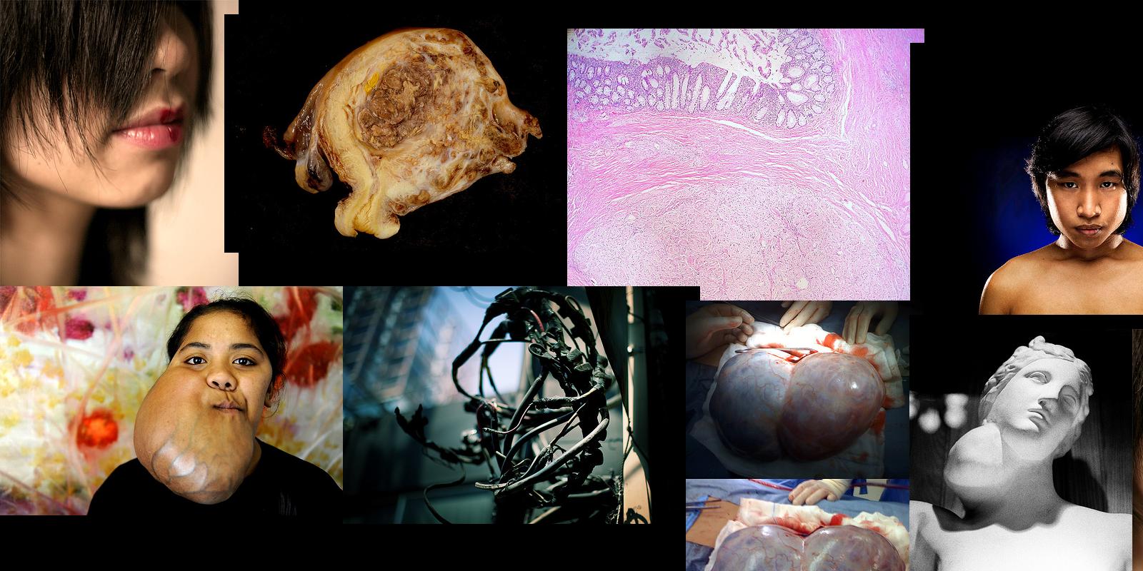 tumor